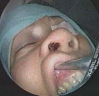 Figure 1: Endoscope was introduced after stab wound incision was performed above the gingivolabial sulcus at the right canine fossa